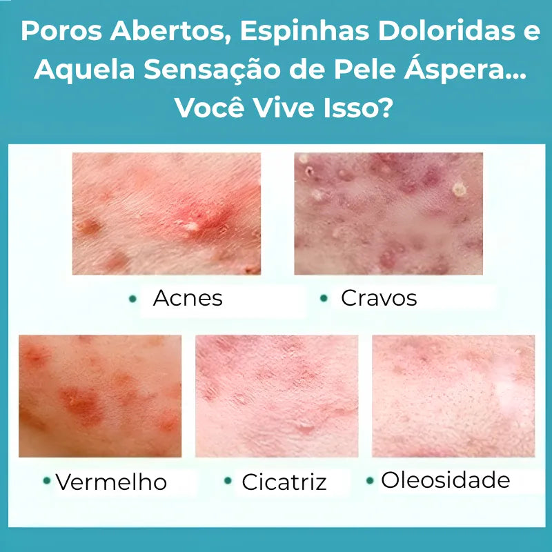 Gel secativo para espinhas Jole Store