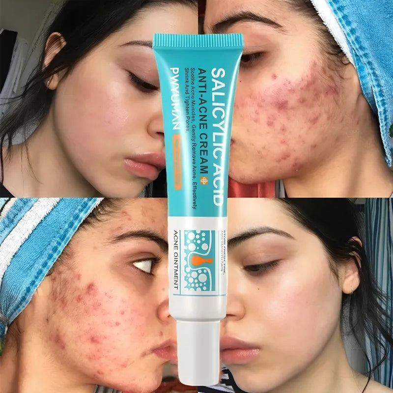 Gel secativo para espinhas Jole Store