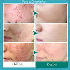 Gel secativo para espinhas Jole Store