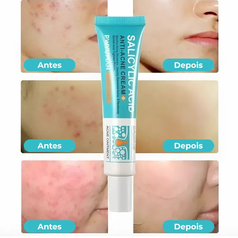 Gel secativo para espinhas Jole Store