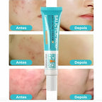 Gel secativo para espinhas Jole Store