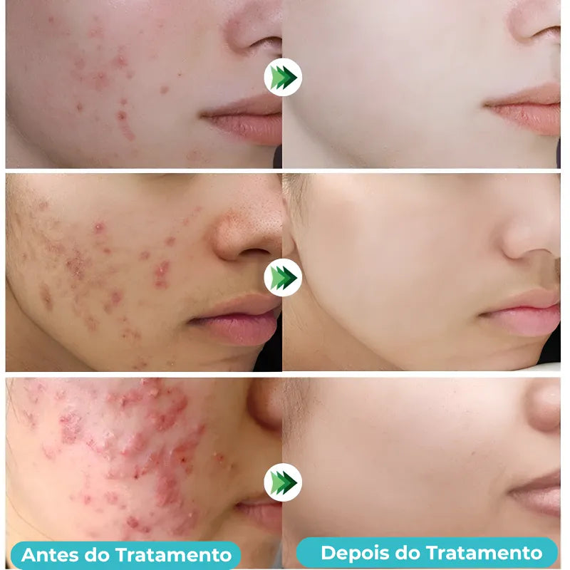 Gel secativo para espinhas Jole Store