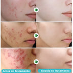 Gel secativo para espinhas Jole Store