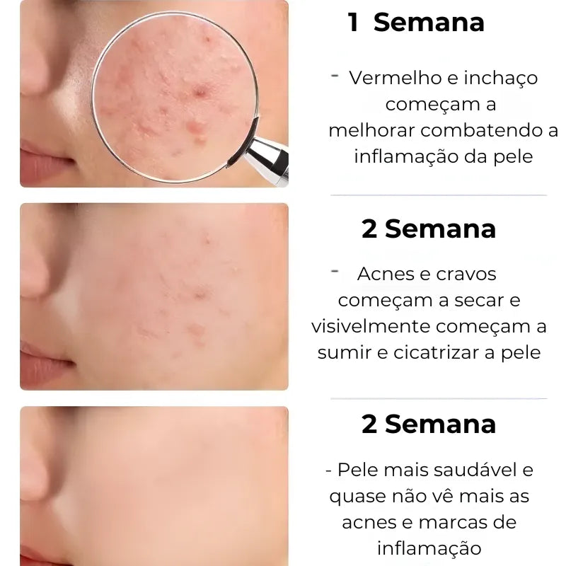 Gel secativo para espinhas Jole Store