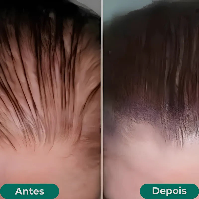 Queda de Cabelo Jole Store